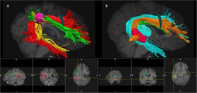 Functional Contributions of the Arcuate Fasciculus to Language Processing